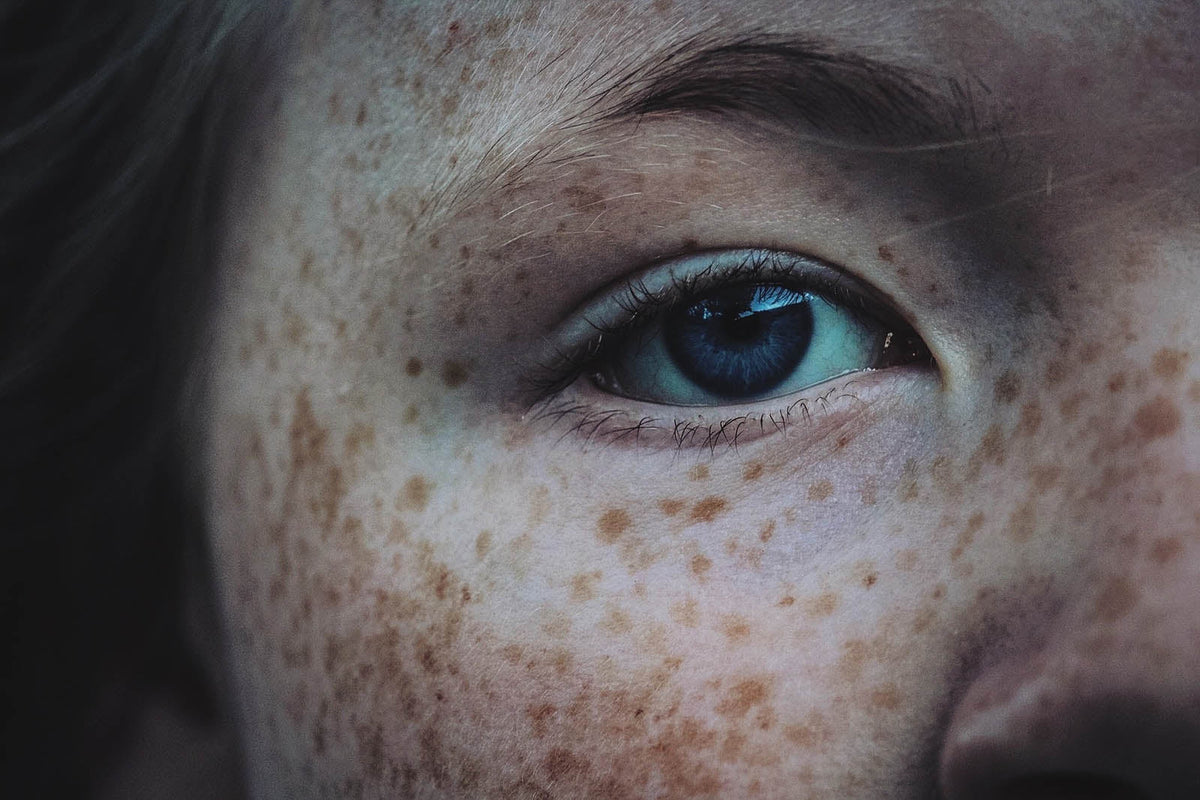 5 Causes of Inflammation-Induced Hyperpigmentation - Sente Labs