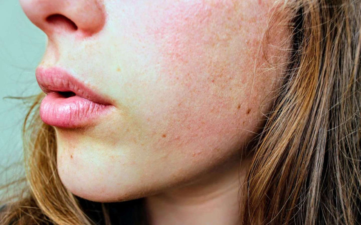 How to Reduce Inflammation on the Skin - Sente Labs