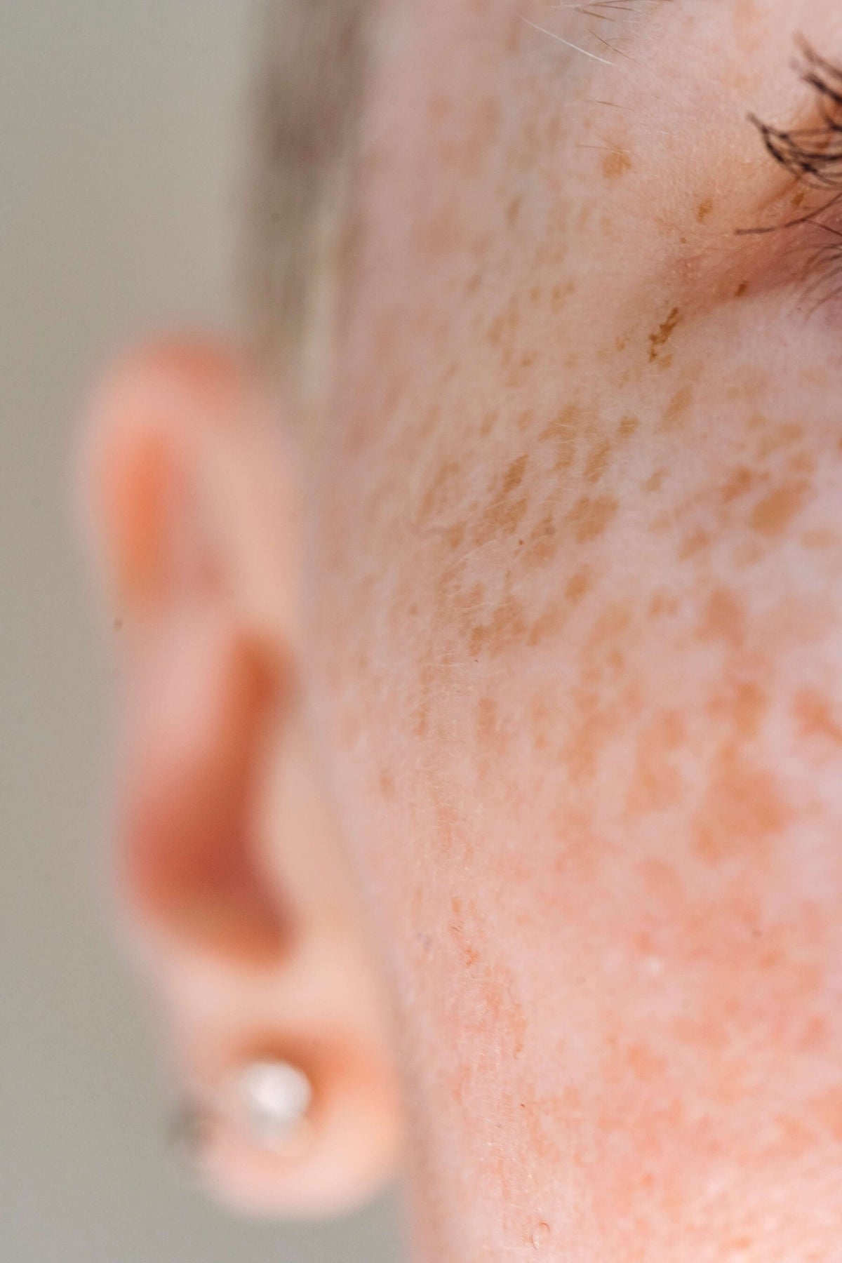 What is Hyperpigmentation & What Solutions are There? - Sente Labs