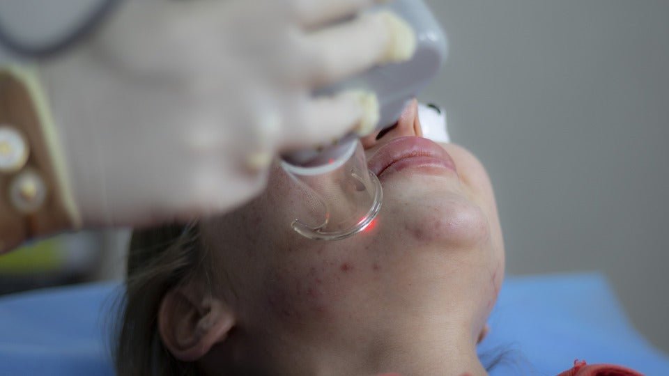 What You Need To Know About Laser Treatment Options For Rosacea - Sente Labs