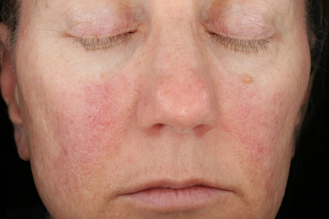 Before and After- before image showing hyperpigmentation on face