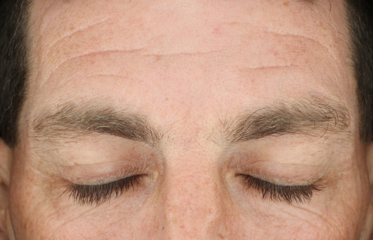 Before and After- before image showing deep wrinkles on forehead