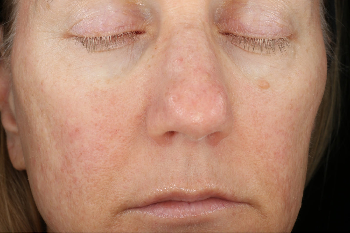 Before and After- after image showing reduced hyperpigmentation on face