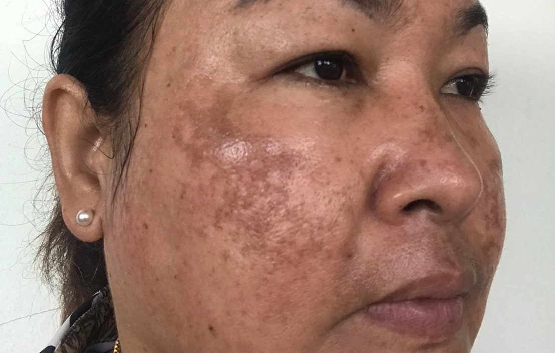 Before and After- before image showing uneven pigment on cheek