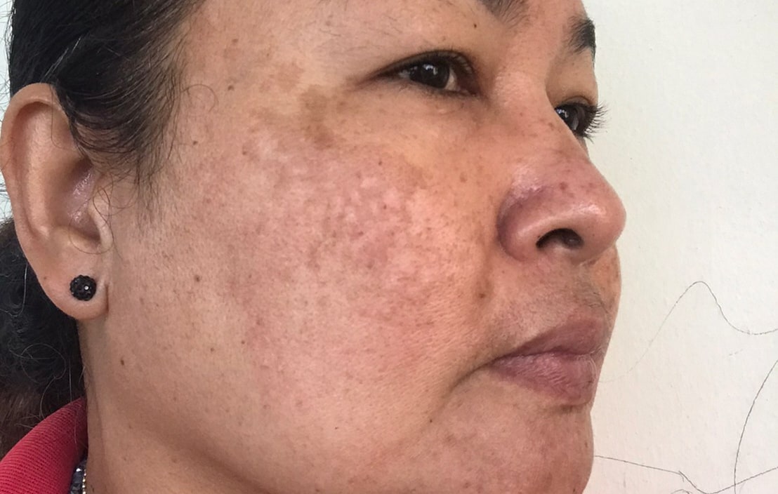 Before and After- after image showing significantly improved skin tone on cheek