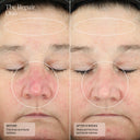 before and after reduced fine lines and facial redness