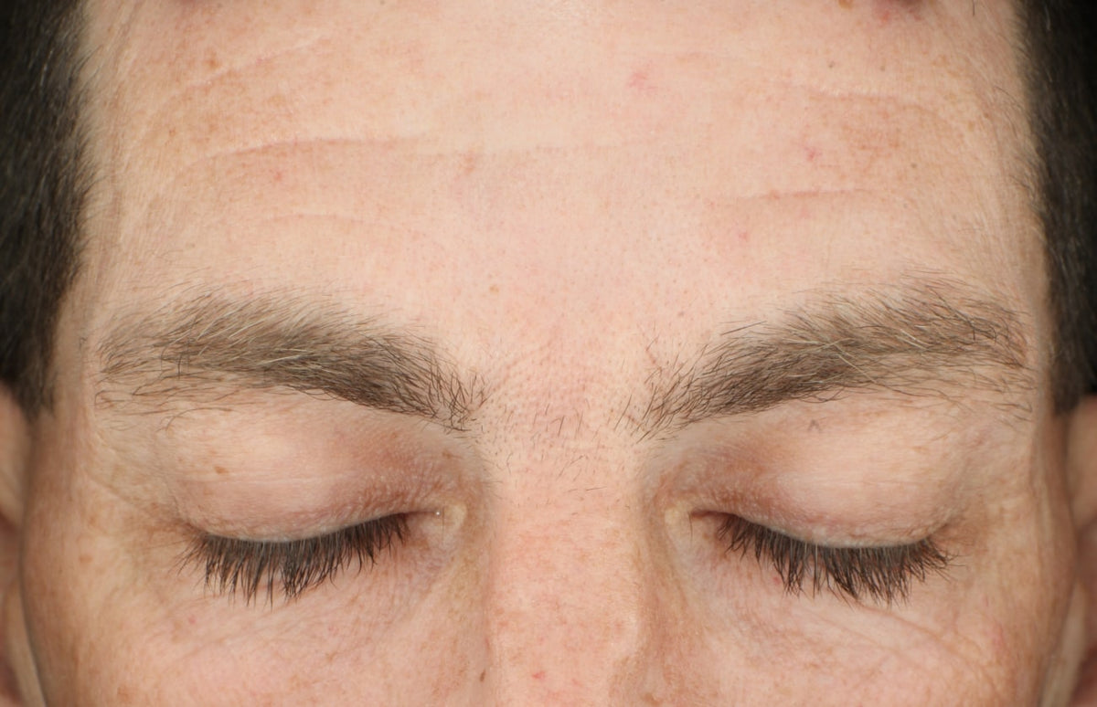 Before and After- after image showing lessened wrinkles on forehead with out surgery