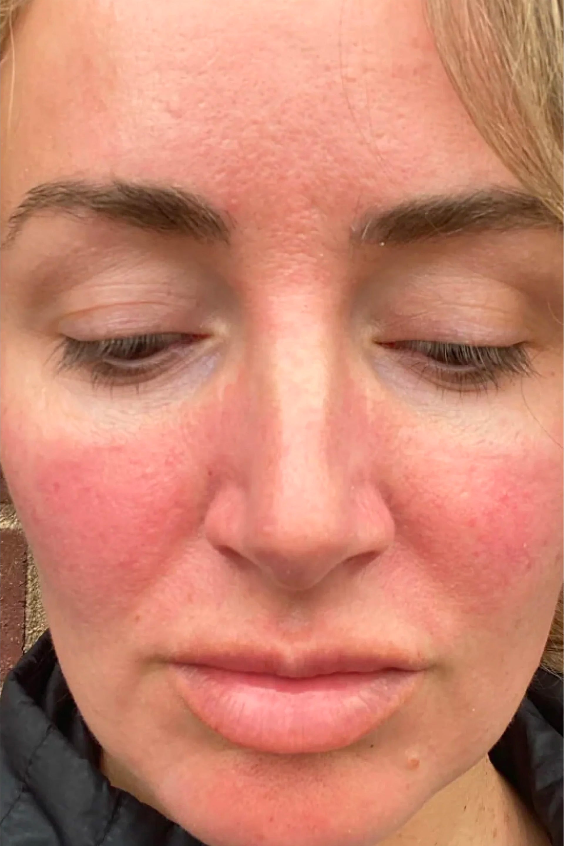 The Redness Solution